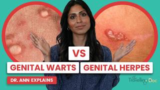 GENITAL WARTS Verses HERPES - Doctor Explains, Symptoms, Treatments. TheTravellingDoc.com