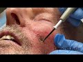 removal of a basal cell cancer on the face