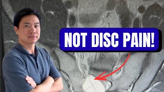 Tarlov Cysts | 3 Signs You Shouldn’t Ignore