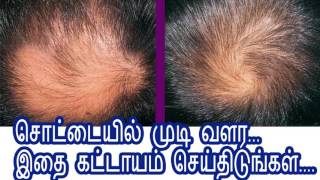 சொட்டையில் முடி வளர    இதை கட்டாயம் செய்திடுங்கள்     1