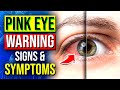 CONJUNCTIVITIS | Warning Signs of PINK EYE