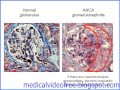 anca vasculitis pathology