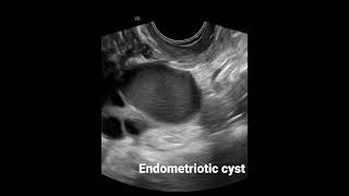 Right ovarian Endometriotic cyst