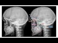 X-ray of the Skull and Paranasal Sinus (Tutorial by Dr. Nazif)