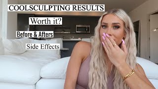 Does Coolsculpting Work? Results + Review