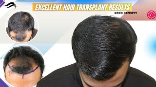 Hair Transplant In Trichy | Best Clinic Cost Results \u0026 Surgeon Of Hair Transplant In Trichy