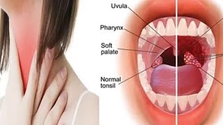 How to get rid of Sore throat | Home remedies for treatment of tonsillitis sore throat naturally |