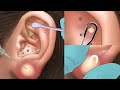 Satisfying ! ear pimple blackhead care | ear exfoliation | sebaceous cyst removal | tingle