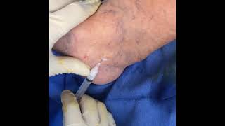 Varicose and Spider Vein Treatment with Schlerotherapy by Dr Garcia