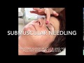 Michelle Gellis teaches acupuncture needling of corrugator muscle for facial cosmetic acupuncture