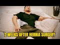 My Progress 2 WEEKS AFTER my HERNIA SURGERY at Shouldice Hospital