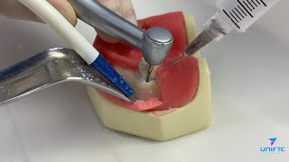 Passo-a-passo de odontossecção de molar inferior