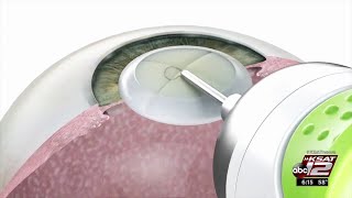 Miloop Removes Cataracts In A Flash