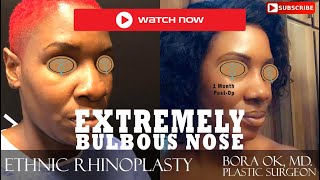 Dr. Bora Ok, MD. - Ethnic Rhinoplasty (Natural Nose Job) Surgery - Before & After Transformation