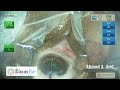 ab interno canaloplasty with the itrack system