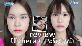 รีวิว Ulthera เครื่องยกกระชับผิวหน้า ผลลัพธ์หลังทำ 1 เดือนเป็นไง? คุ้มราคา? เจ็บมั้ย? | This is Pear