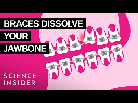 Do braces have mercury in them?