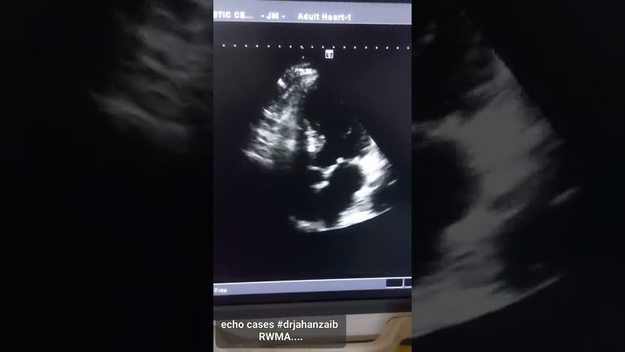 Echo Cases Rwma In Ihd Youtube
