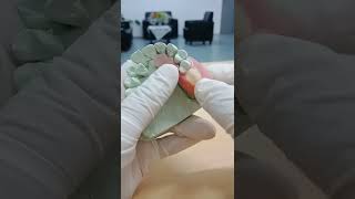 gigi palsu valplast flexible denture