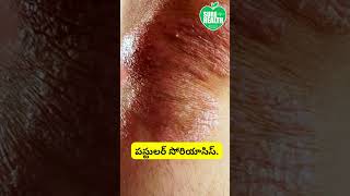 సోరియాసిస్ రకాలు/Types of Psoriasis