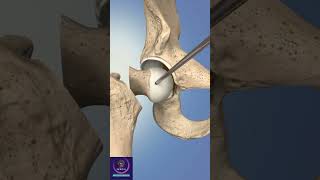 Hip Replacement Anterior Surgery #shorts #education