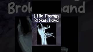 Little Timmy’s broken hand 🖐️