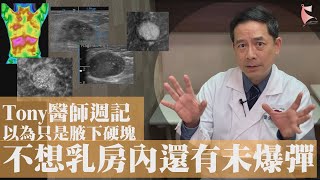 【Tony醫師週記50】以為只是腋下硬塊 不想乳房內還有未爆彈