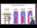 THROMBOSIS || DVT || complete cure A success story || Dr. Ram singh solanki