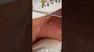 Skincare | Blackheads Removal #649 #tweezers skincare #blackheads blackheads