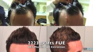 ASMED - Dr. Koray Erdogan - 1800 Grafts FUE #hairtransplant #hairtransplantturkey