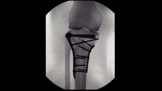 Bicondylar Tibial Plateau  Fractures   (A touch Surgery - Apps TM) )