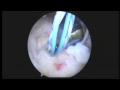 CM R rotator cuff repair and biceps tenodesis 12 29:14