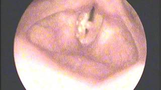 Left vocal cord polyp by Prof Dr Mohamed M. El-Sawy