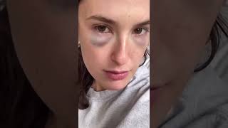 Blepharoplasty 1 Month After