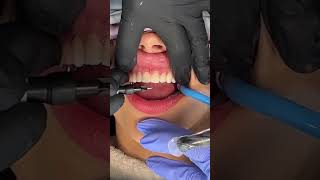 On The Way To Incredible Porcelain Veneers - Inside the Process