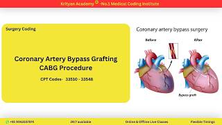 How to code CABG procedure?