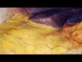 laparoscopic exploration with finding of gallbladder mass