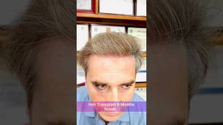 Super Natural Hairline 🌱 | Hairline Challenge #hairlosstreatment #hair