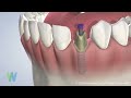 Dental implants at Westwood Oral Surgery & Dental Implants