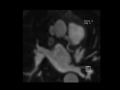 ascending aortic pseudoaneurysm after graft repair