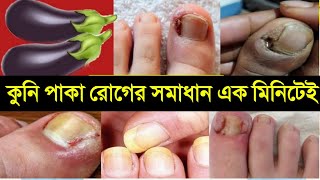 নখের কুনি রোগ দূর করার ঘরোয়া উপায় | বেগুন দিয়ে মাত্র ১ মিনিটেই নখ কুনি, কুনি পাকা, কুনির ব্যথা দূর!