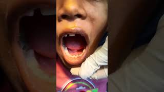 Bacho Ke Dant Kaise Nikalte Hai |Teeth removal#shorts #youtubeshorts #ytshorts #hindi #dental #teeth