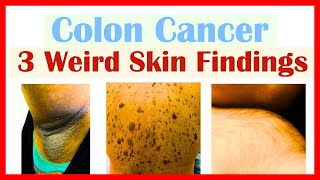 3 Weird Signs of Colon Cancer Found on the Skin
