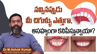 చిగుళ్లు ఎత్తుగా ఉంటే || Gummy Smile Correction In Telugu || Gummy Smile Causes || Eledent Hospitals