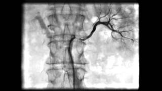 Ангиография левой почечной артерии. Локальный стеноз