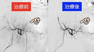 モヤモヤ血管ギャラリー「グロインペイン症候群（内側大腿回旋動脈）」