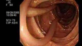 Colonoscopy Demonstrating a Moving Worm