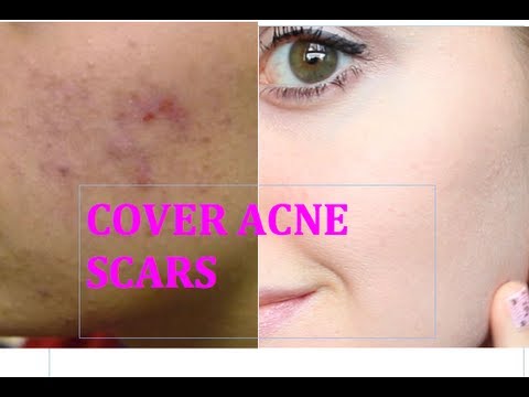 HOW TO COVER UP ACNE SCARS AND BLEMISHES - YouTube