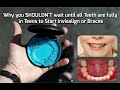 Why you SHOULDN'T Wait until all Teeth Come in to Start Braces or Invisalign