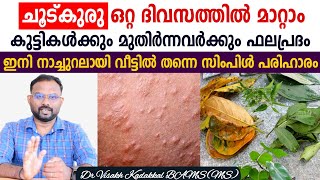 ചൂട്..വിയർപ്പ്..ചൂട് കുരു..ചൊറിച്ചിൽ 🥵 ഒറ്റ ദിവസത്തിൽ മാറാൻ നാച്ചുറൽ പരിഹാരം 💯 | Dr Visakh Kadakkal